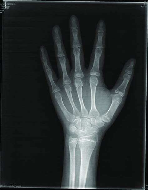 Anteroposterior Radiograph Of The Left Wrist Prompted That His Bone Age