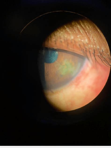 Slit-lamp examination showing dendritic corneal ulcer after COVID-19... | Download Scientific ...