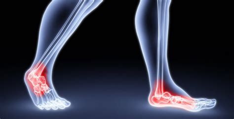 Could That Pain In Your Foot Be Arthritis — Foot And Ankle Specialists