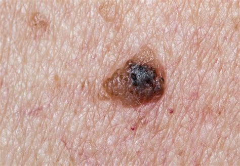 Moles And Warts Clear Choice Dermatology