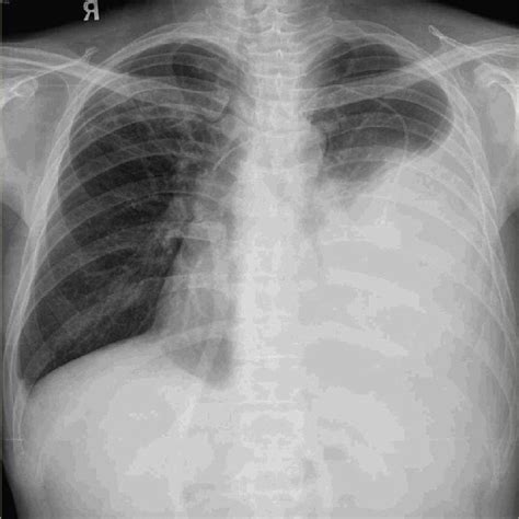 Chest X Ray Showing Massive Left Pleural Effusion Download