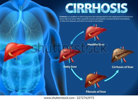 Informative Poster Alcoholic Liver Disease Cirrhosis Stock Vector ...