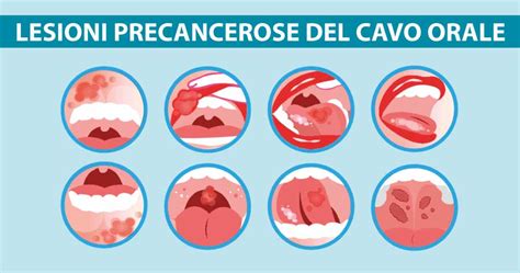 Lesioni Precancerose Del Cavo Orale Studio Dentistico Michelangelo 13