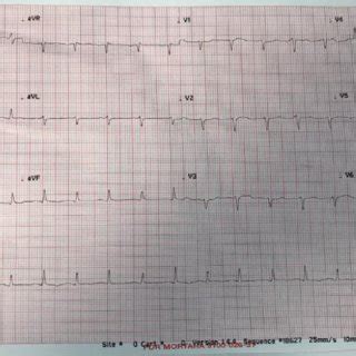 (case 1): Electrical (Pulsus) alternans. | Download Scientific Diagram