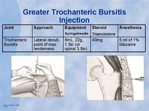 Trochanteric Bursitis Injection Technique