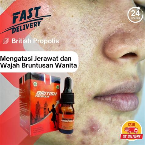 Jual British Propolis 6ml Obat Herbal Jerawat Wanita Punggung Batu Salep Bruntusan Cream Krim