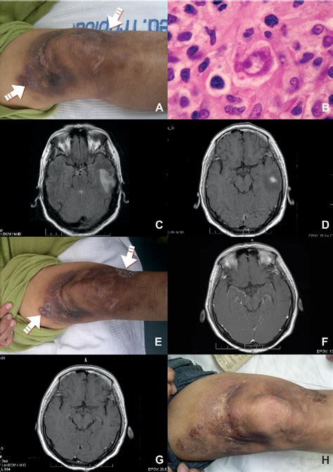 PDF Successful Treatment Of Balamuthia Mandrillaris Amoebic Infection