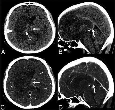 Atypical Deep Cerebral Vein Thrombosis With Hemorrhagic Venous