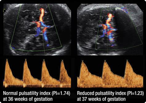 Doppler of the middle cerebral artery for the assessment of fetal well
