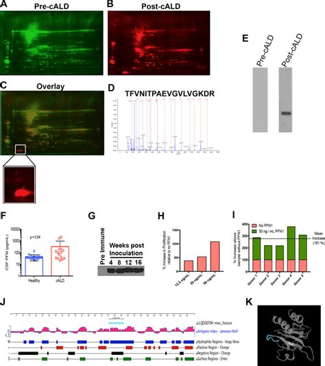 Identification Of Auto‐reactivity To Pfn1 A 2d Blot Western Blot Of