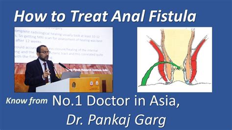 What Is Anal Fistula Know Cause Successful Treatment From Asia No Surgeon Dr Pankaj Garg