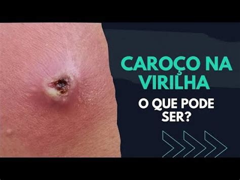 Aprender Sobre 90 Imagem Como Tirar Cravo Da Virilha Br Thptnganamst