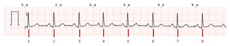 Electrocardiograma Ecg Normal Valores Y Ondas Normales