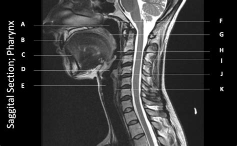 Pharynx & Larynx: Sagittal Section MRI Diagram | Quizlet