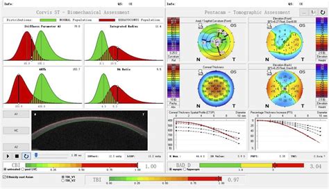 Corneal Morphological And Biomechanical Changes In Thyroid A Cornea