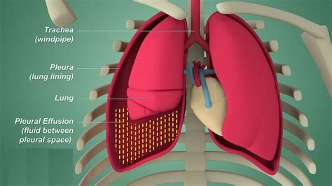 Pleural Effusion Internal Medicine Etiology Clinical Features Diagnosis And Treatment