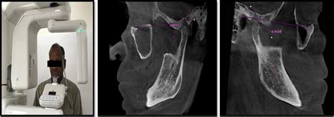 Cone Beam Computed Tomography CBCT Scan CBCT Analysis And Sagittal