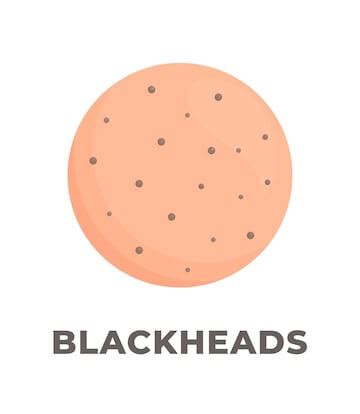 What are Blackheads? Causes & Prevention - St.Botanica