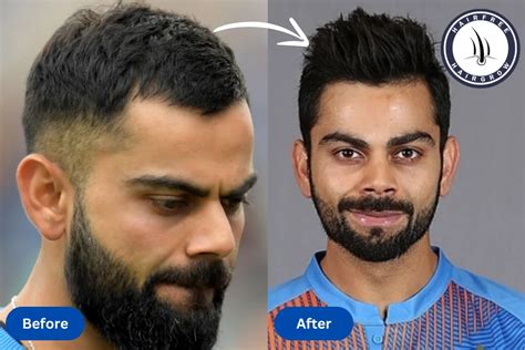 Virat Kohli Hair Transplant: Complete Journey & Transformation