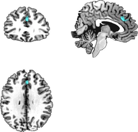 Regions Of Statistically Significantly Smaller Gray Matter Volume In