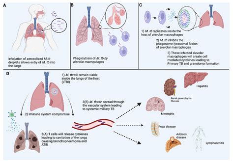 Overview Of The Manifestation And Pathophysiology In Tb Infection As