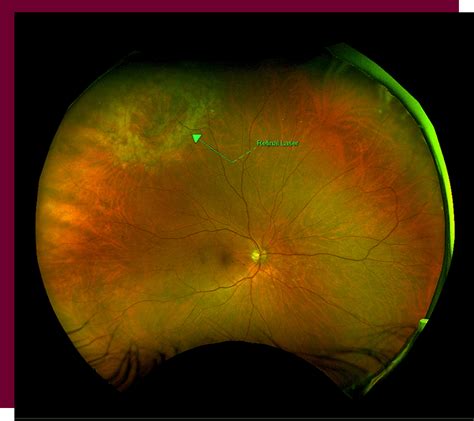 The Retina Clinic Retinal Laser Treatment