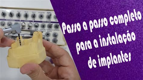 Instala O De Implantes Passo A Passo Completo Youtube