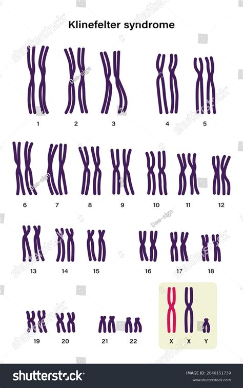 Klinefelter Syndrome Chromosome