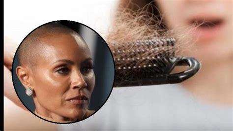 Jada Pinkett Smith Lucha Contra La Alopecia Detalles