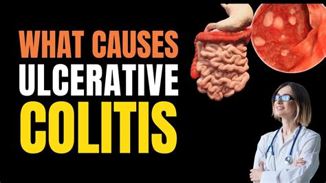 What Causes Ulcerative Colitis? - E-Healthy Info