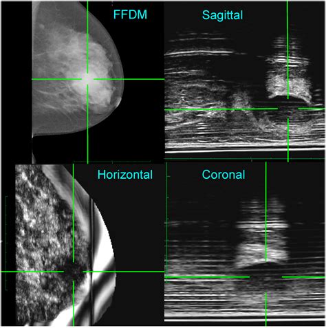 Diagnostics Free Full Text Detecting Breast Cancer With A Dual