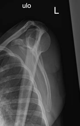 Posterior Shoulder Dislocation With Reverse Hill Sachs And Reverse Bony