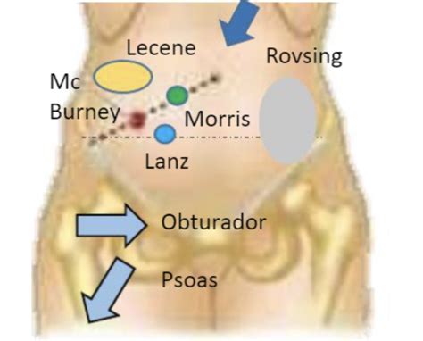 Prueba De Puntos De Mcburney