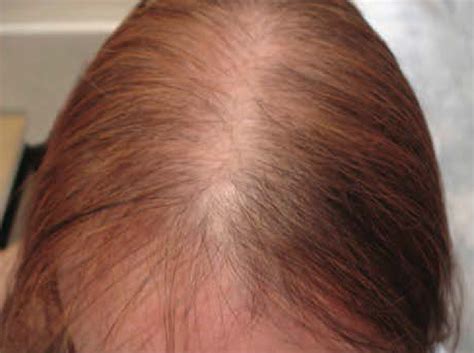 Alopecia Origem Tipos E Tratamentos