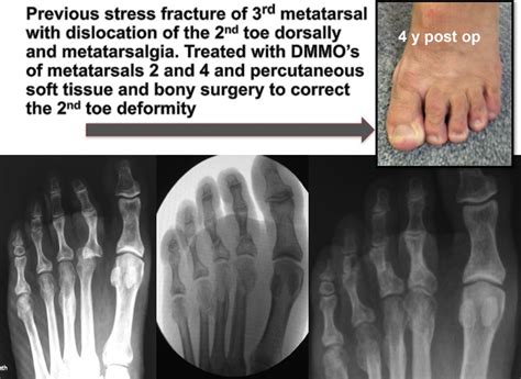 Treatment of Metatarsalgia with Distal Osteotomies - Foot and Ankle Clinics