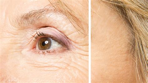 Causes and Home Remedies for Eyelid Wrinkles | Eyelids Lift