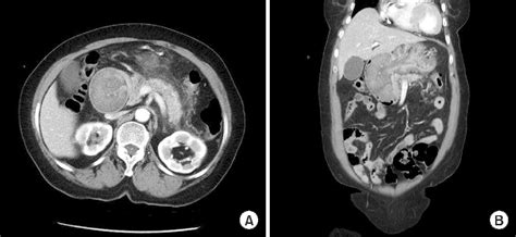 Figure 1 From Gastroduodenal Intussusception Resulting From Large Hyperplastic Polyp Semantic