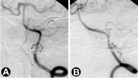 Postoperative Left Vertebral Angiograms A Anteroposterior View And