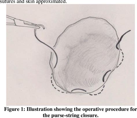 Figure From Comparison Of Purse String Versus Conventional Closure Of