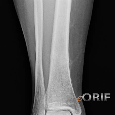 Icd 10 Code For Left Tibia Fibula