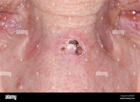 El Carcinoma De Células Basales Cáncer De Piel Close Up De Un