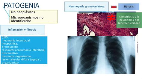 Enfermedades Pulmonares Intersticiales Ppt