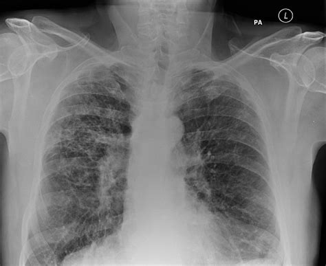 Mild Cylindrical Bronchiectasis Comprehensive Guide To Treatment