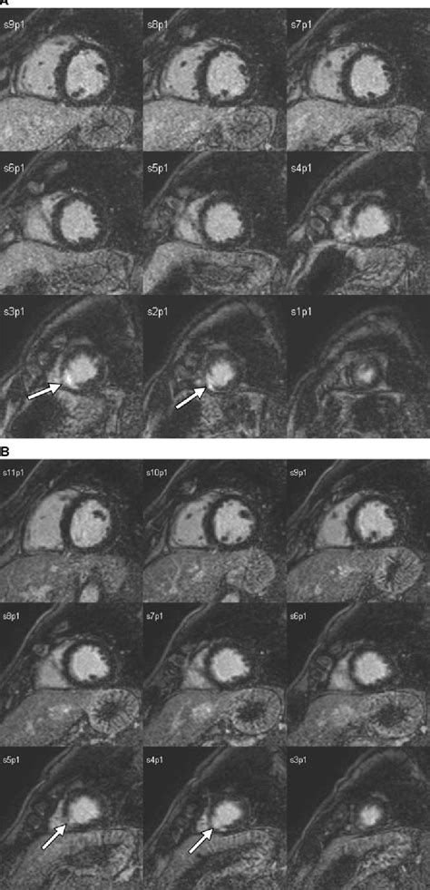 Figure 4 from Cardiac Contusion in a Professional Soccer Player ...