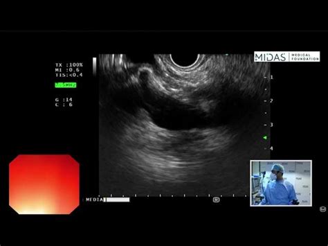 Gastroesophageal Junction Ultrasound