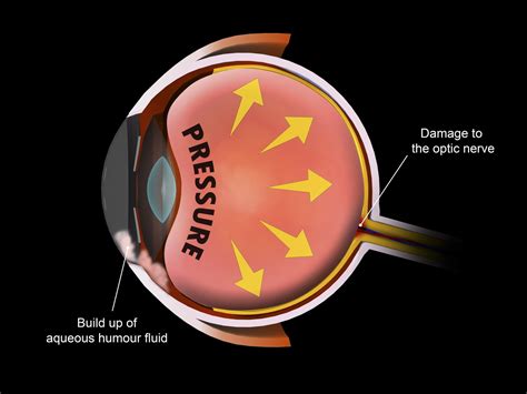 Glaucoma Removal Jackson Ms Eye Institute