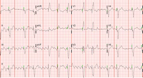 Atrial Flutter With Biventricular Pacing You Can See The Biventricular