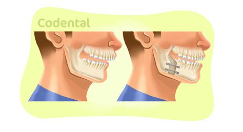 Cirurgia ortognática saiba tudo sobre o procedimento Codental Blog