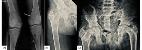 Ap X Ray Of The Bilateral Knee And The Right Proximal Femur Of The Same