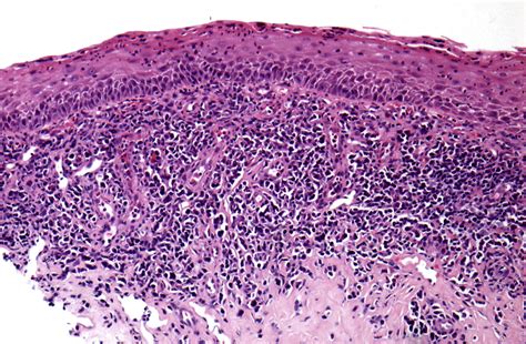 A Practical Guide To Reporting Vulval Inflammatory Lesions Diagnostic